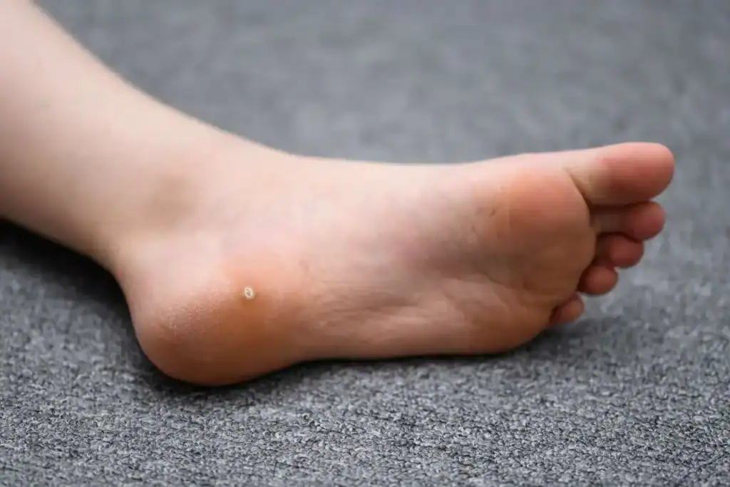 Cryotherapy For Warts And Also Verrucas 2 Image of verruca on the bottom of the foot that able to be treated with Cryotherapy Ruislip