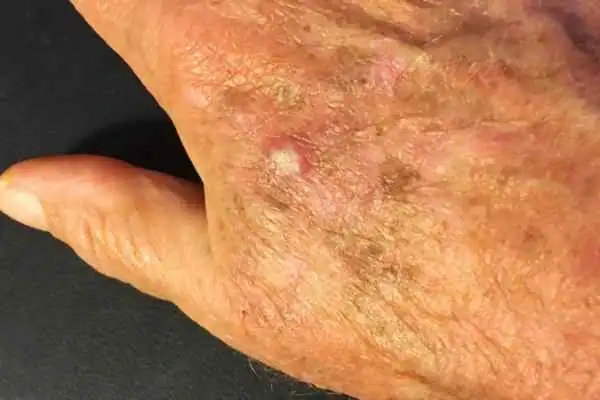 Cryopen For Actinic Keratoses 1 Image of Actinic keratoses Ruislip on a person hand